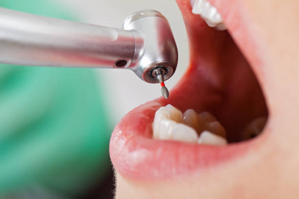 Best Emergency Tooth Extraction in Mount Olive, IL